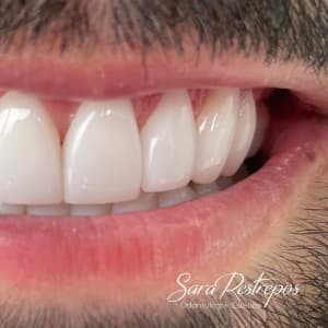 Carillas Dentales en Cali
