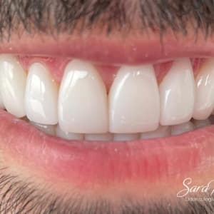 Carillas Dentales en Cali