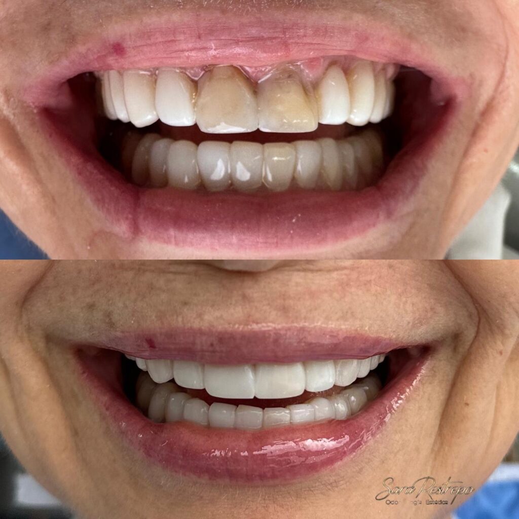 ¿Cuánto vale el diseño de sonrisa en Cali?