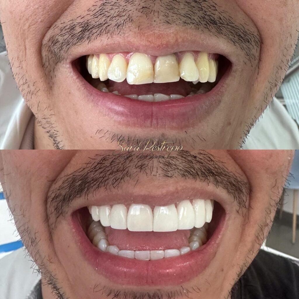 Carillas Dentales en Cali