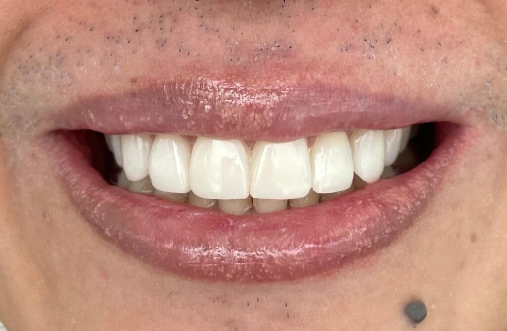 diseño de sonrisa cali
