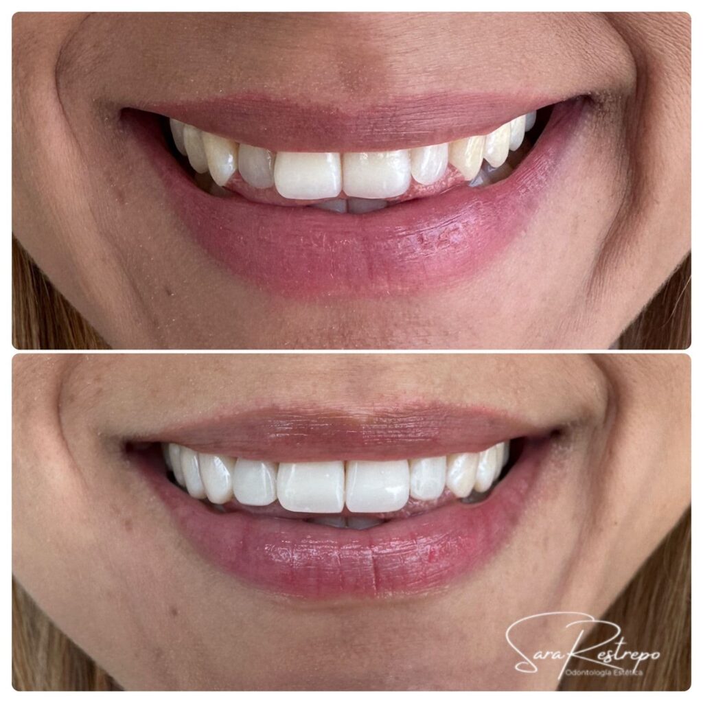 ¿Cuál es el diseño de sonrisa más recomendado?