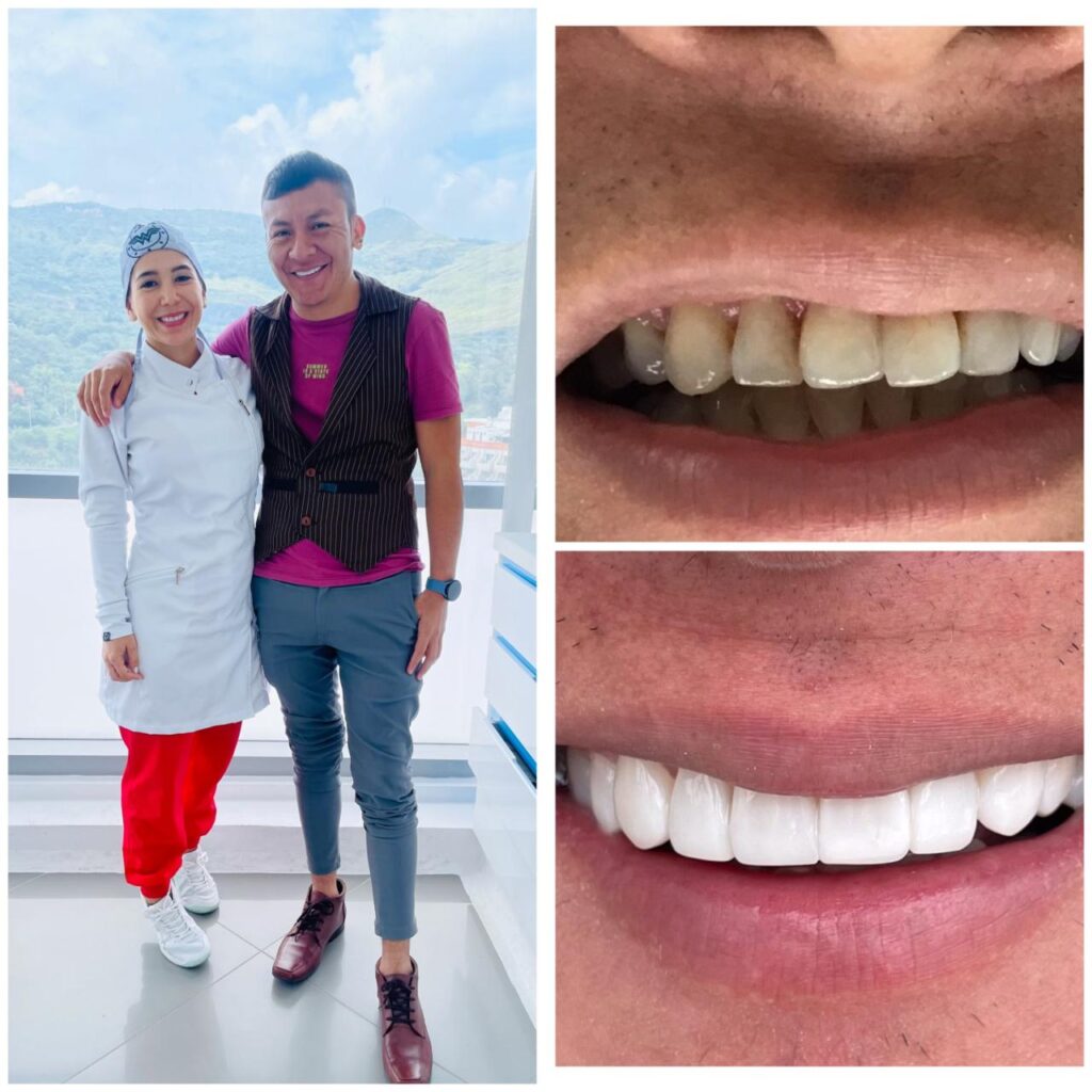 Where do people travel to get veneers