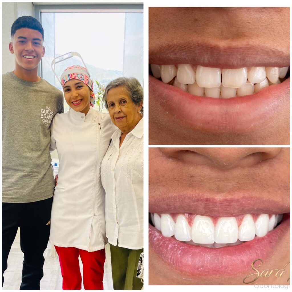 How much does it cost to get veneers in Cali, Colombia