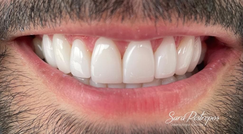 cali colombia veneers price