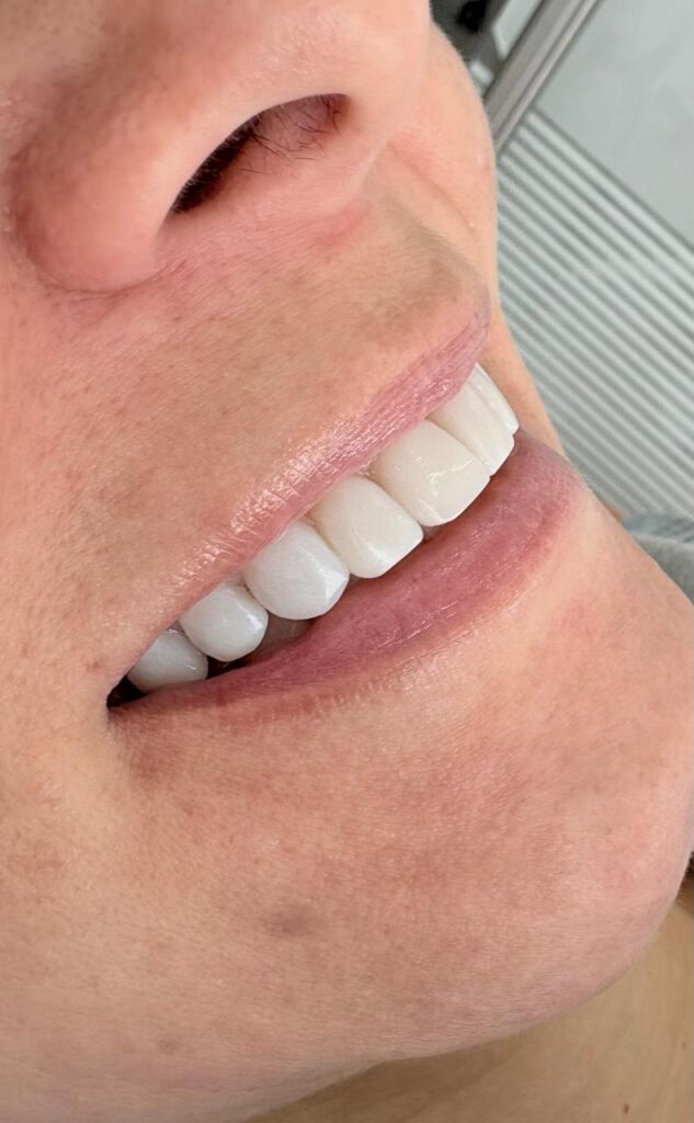 veneer cost in colombia