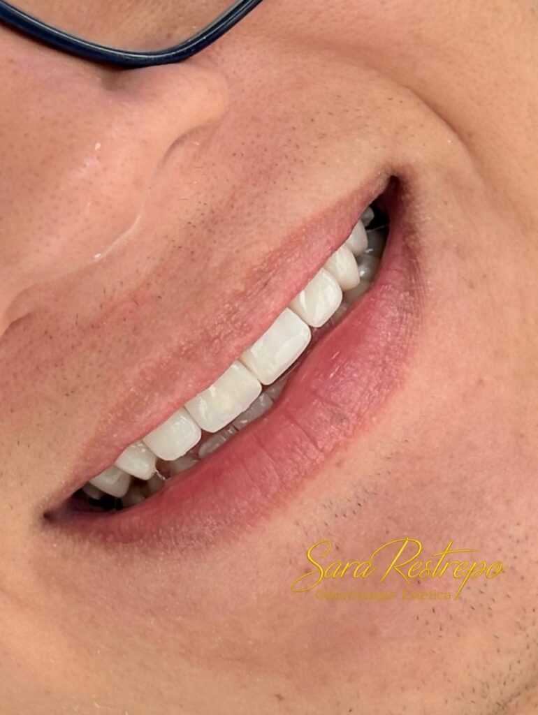 How much is a smile makeover in Colombia?