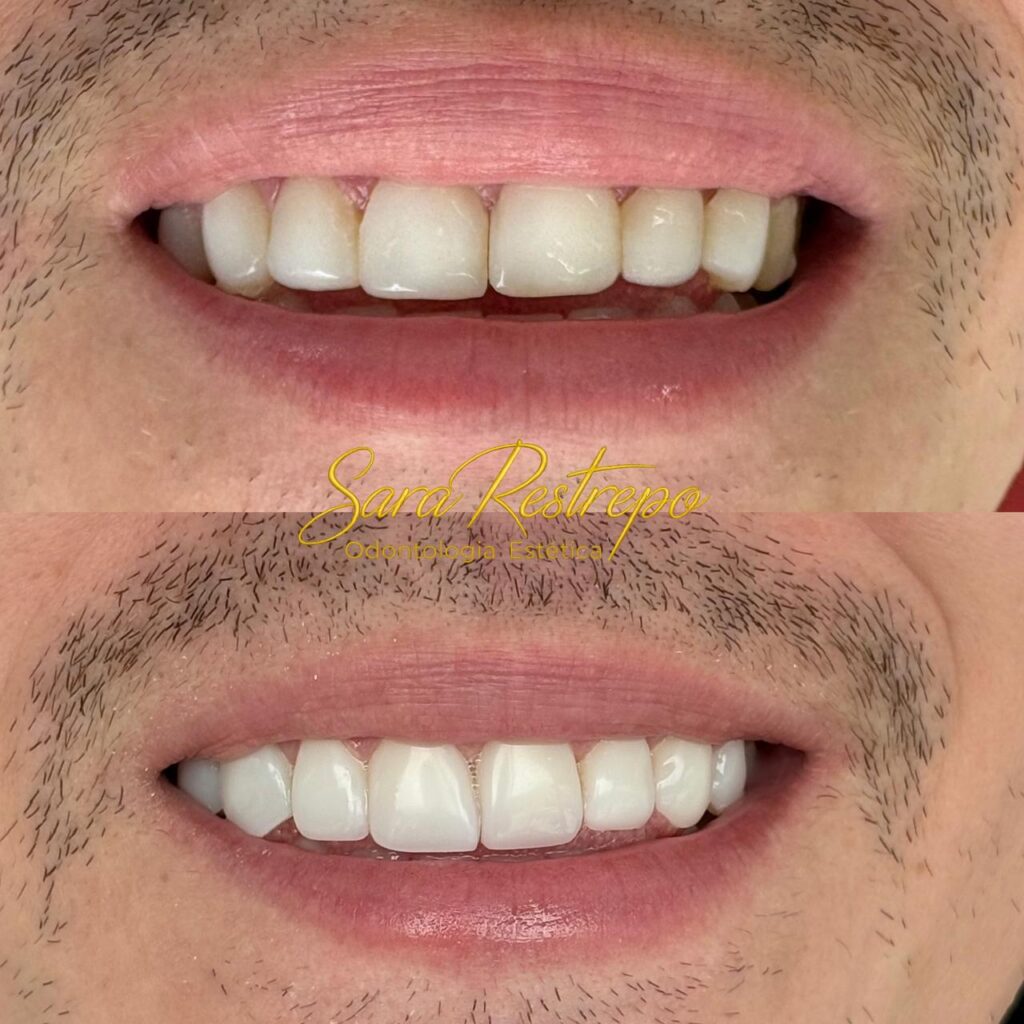 How much does it cost to get veneers in Cali, Colombia?