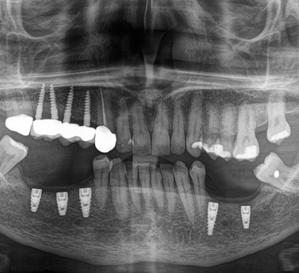 implantes dentales cali
