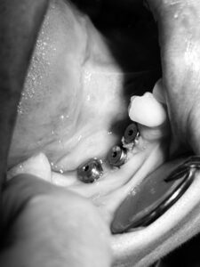 implantes dentales cali