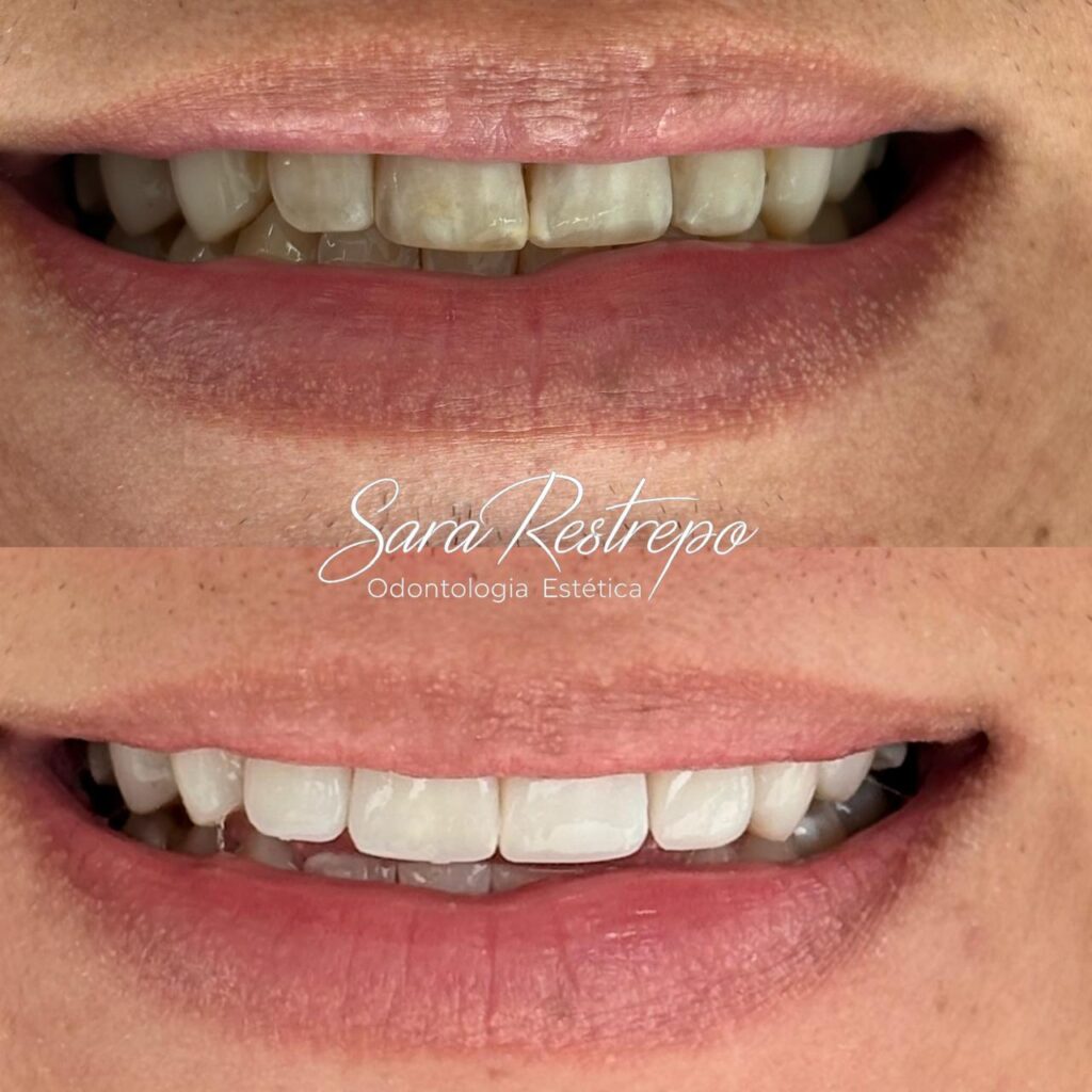 diseño de sonrisa cali colombia