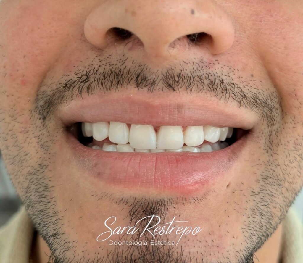 How much does a full set of veneers cost?