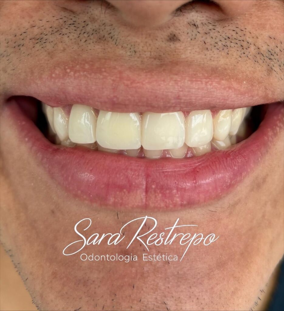 veneers Colombia vs USA cost