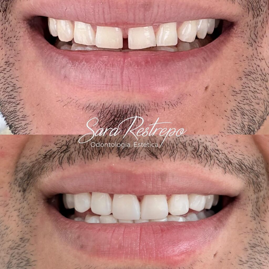 mini diseño de sonrisa precio cali