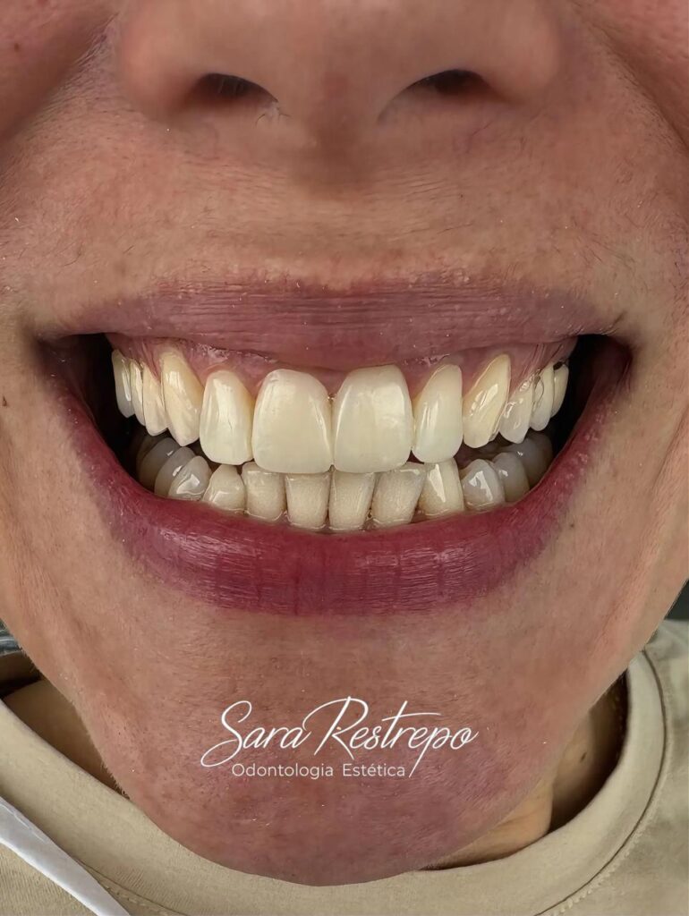 Veneers before and after