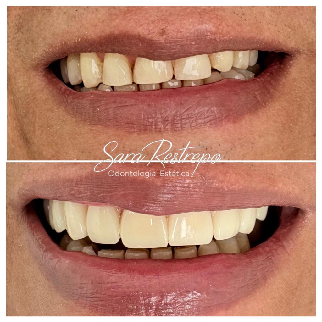 Best dentist for veneers in Colombia