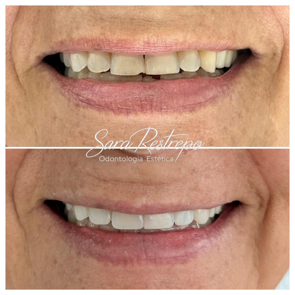 blanqueamiento dental