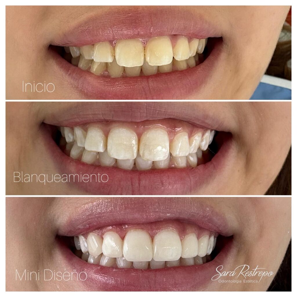 blanqueamiento dental cali precio