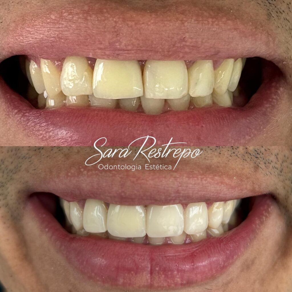 blanqueamiento de dientes