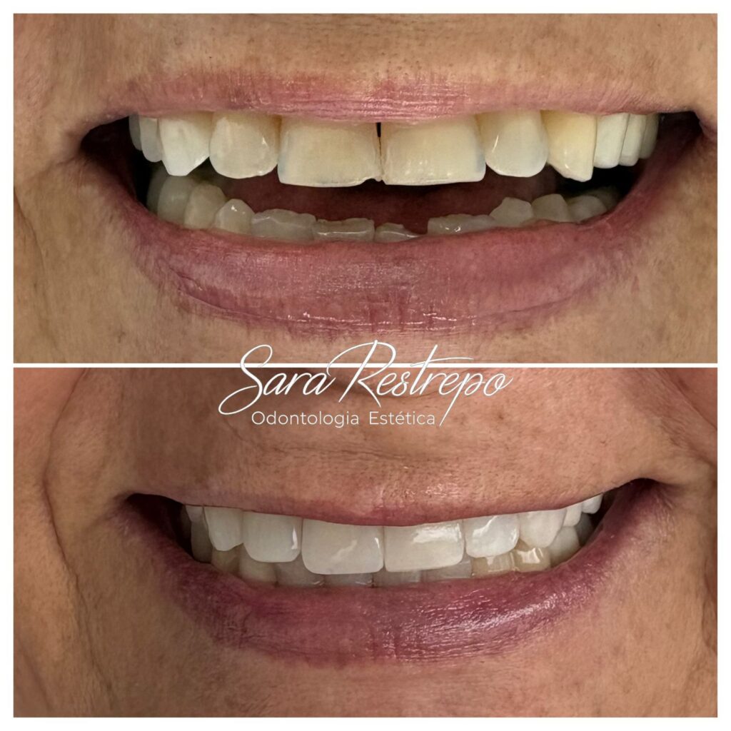 mini diseño de sonrisa precio colombia