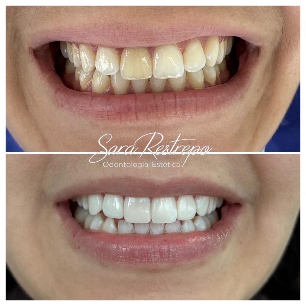 mini diseño de sonrisa precio