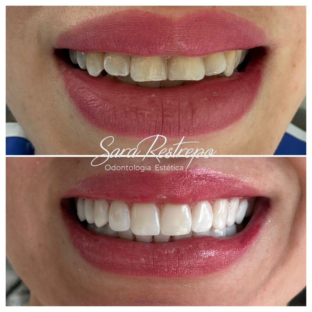 carillas dentales precio cali