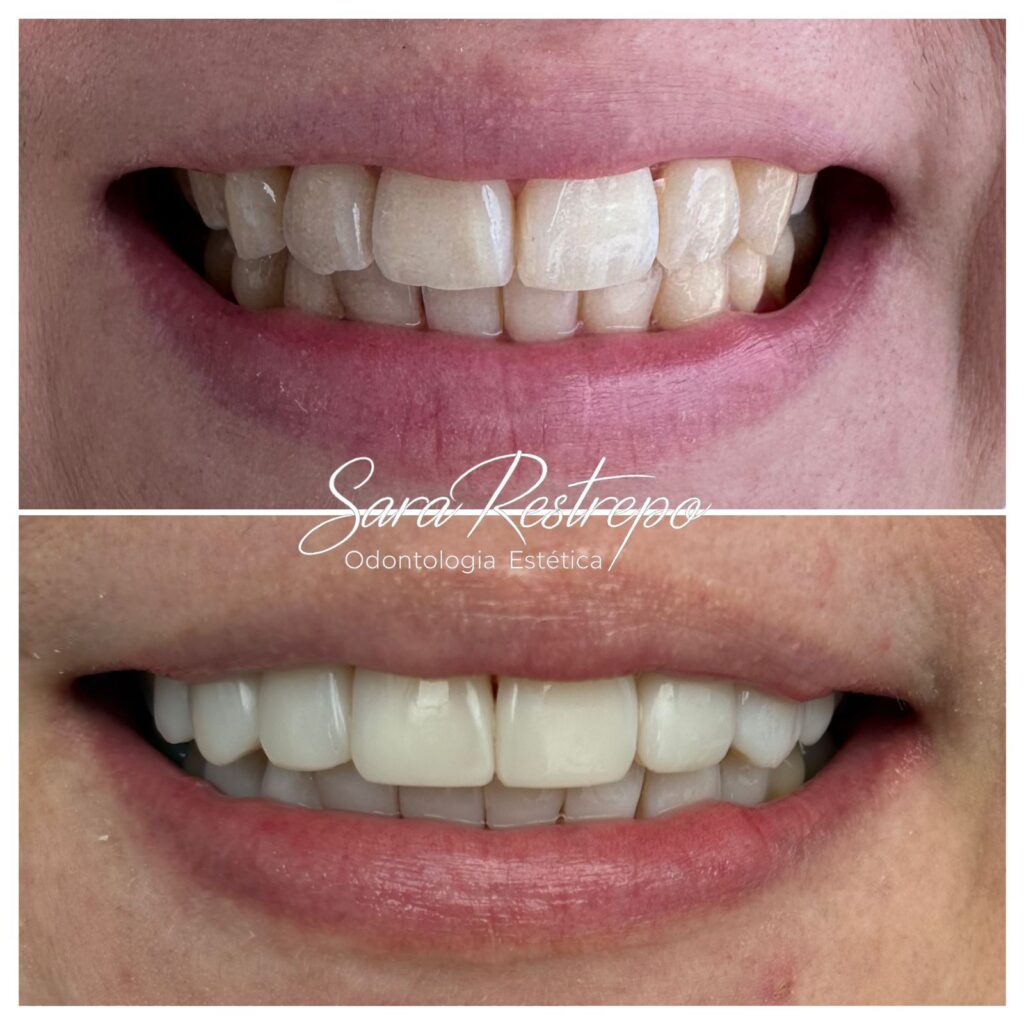 Diseño sonrisa Cali precios