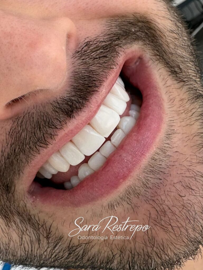 mejores diseños de sonrisa en cali