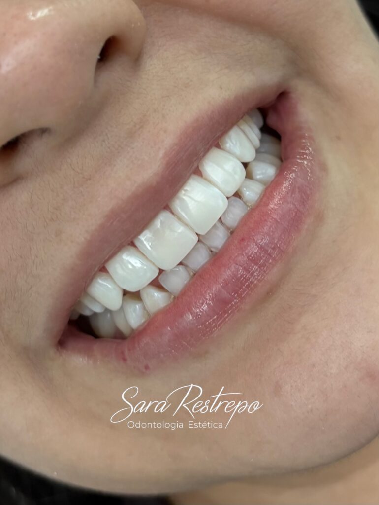 cuanto cuesta un diseño de sonrisa con carillas