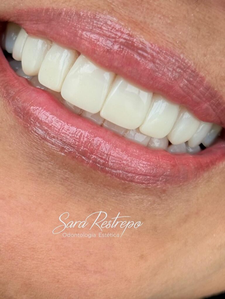 mini diseño de sonrisa