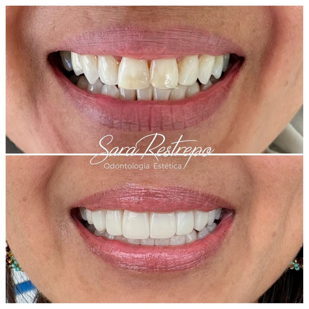 Mini diseño de sonrisa cali precio