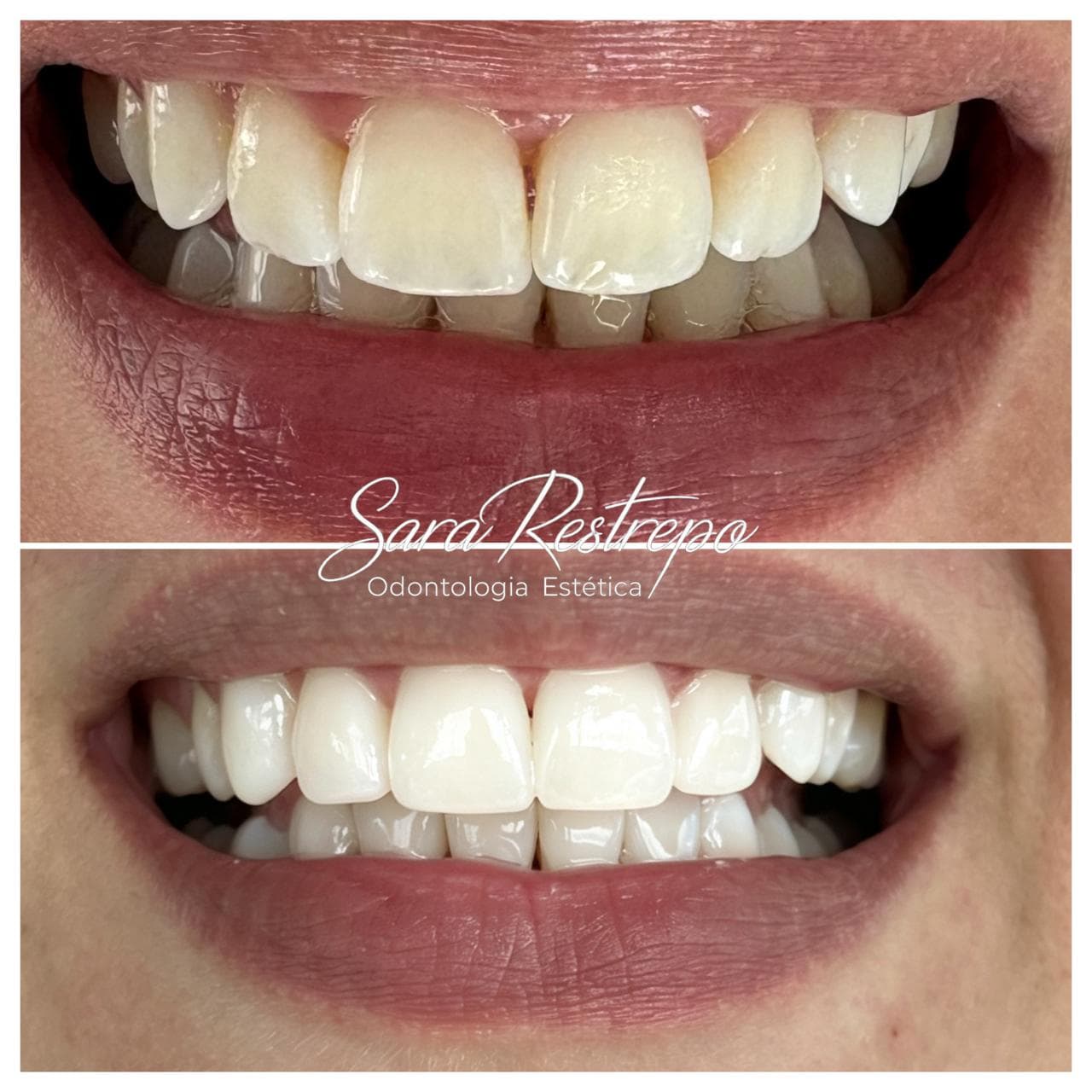 Blanqueamiento dental en Cali, antes y después – Dra. Sara Restrepo