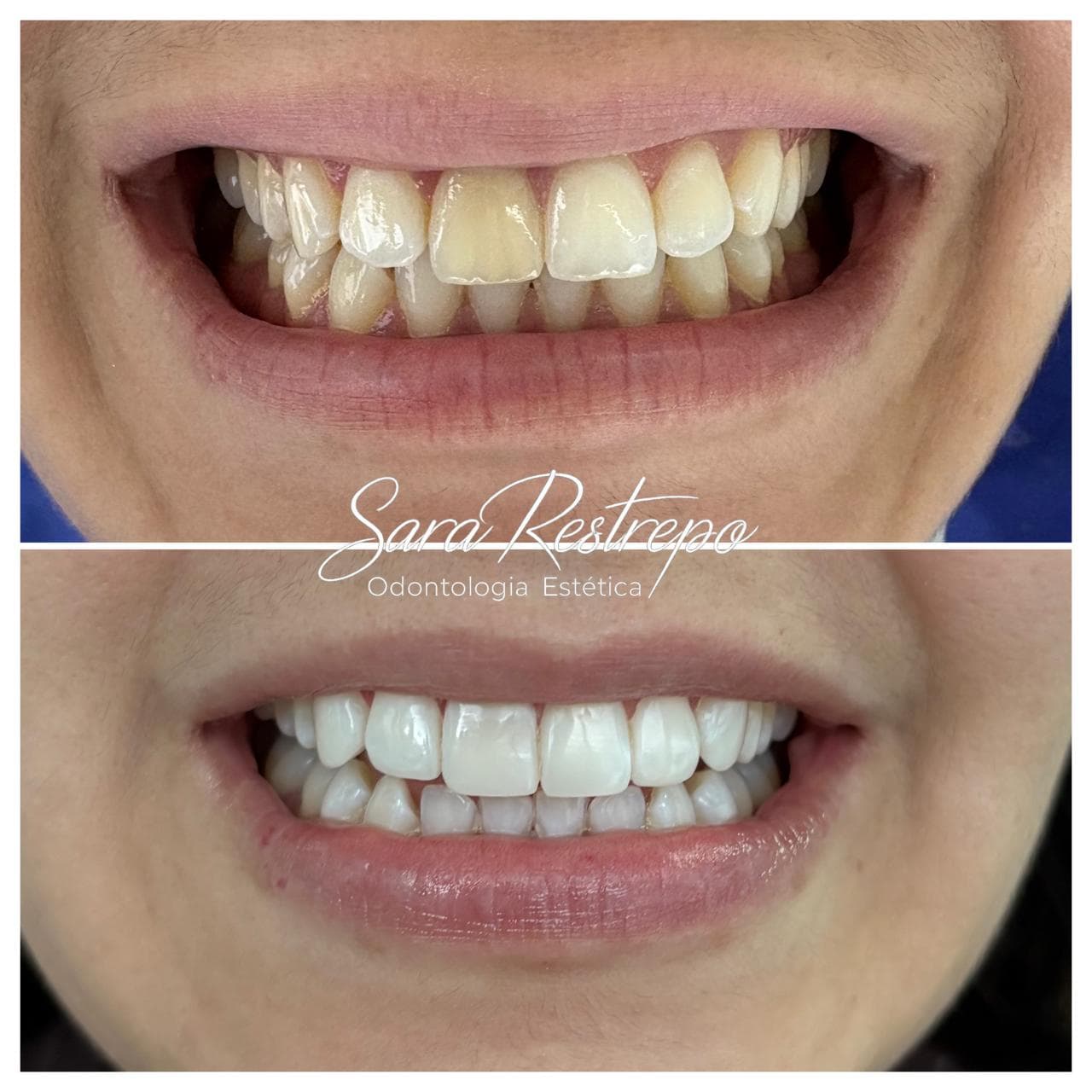 Blanqueamiento dental con luz LED, antes y después – paciente en Cali