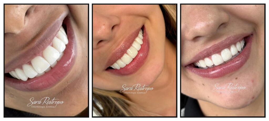 Blanqueamiento dental en cali