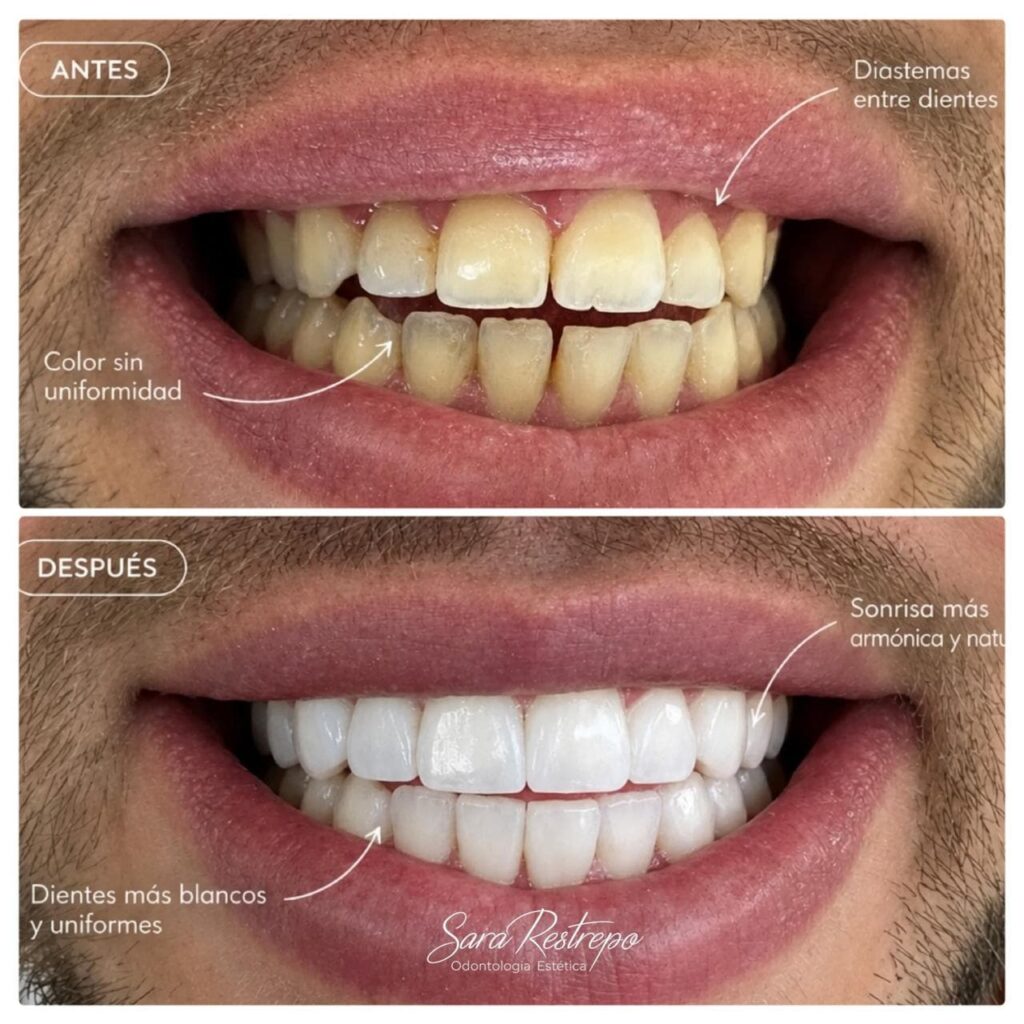 Diseño de sonrisa en resina o cerámica en Cali