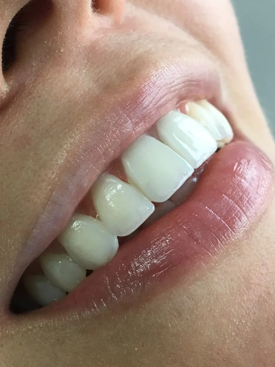 Carillas de cerámica con resultado natural – Dra. Sara Restrepo, Cali