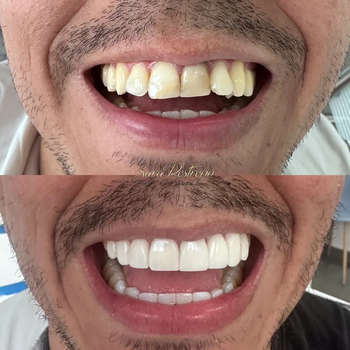 Diseño de sonrisa en cerámica en Cali, antes y después: dientes desgastados a sonrisa uniforme