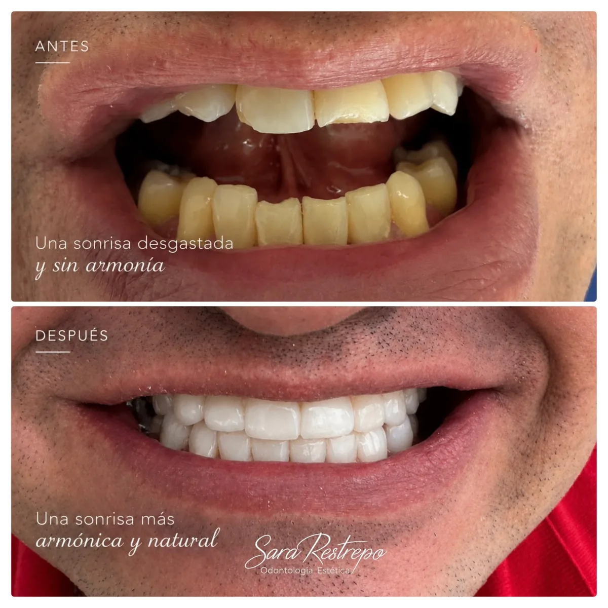Diseño de sonrisa en resina en Cali, antes y después: dientes desgastados a sonrisa armónica