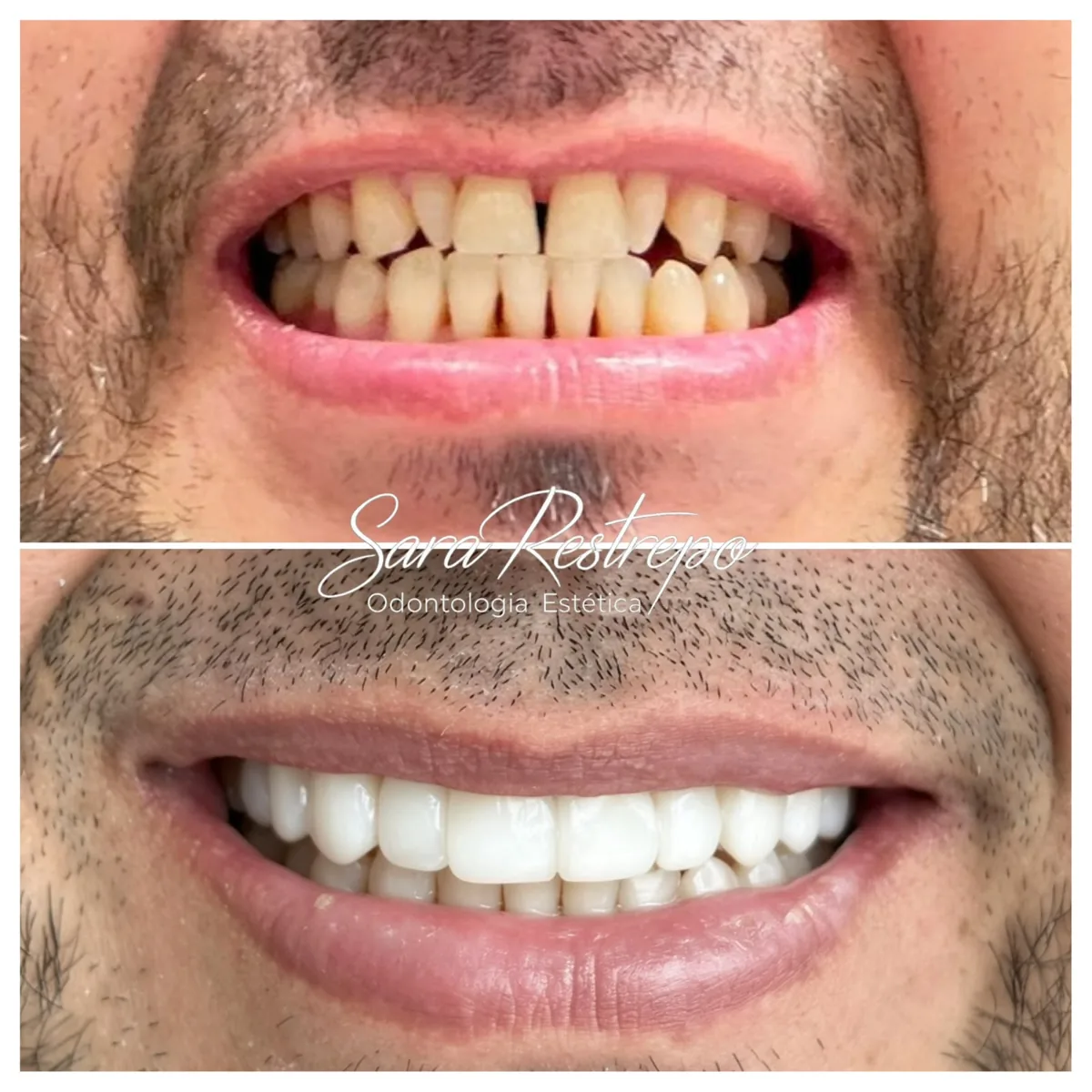Composite veneers in Cali before and after – closed gaps and even color