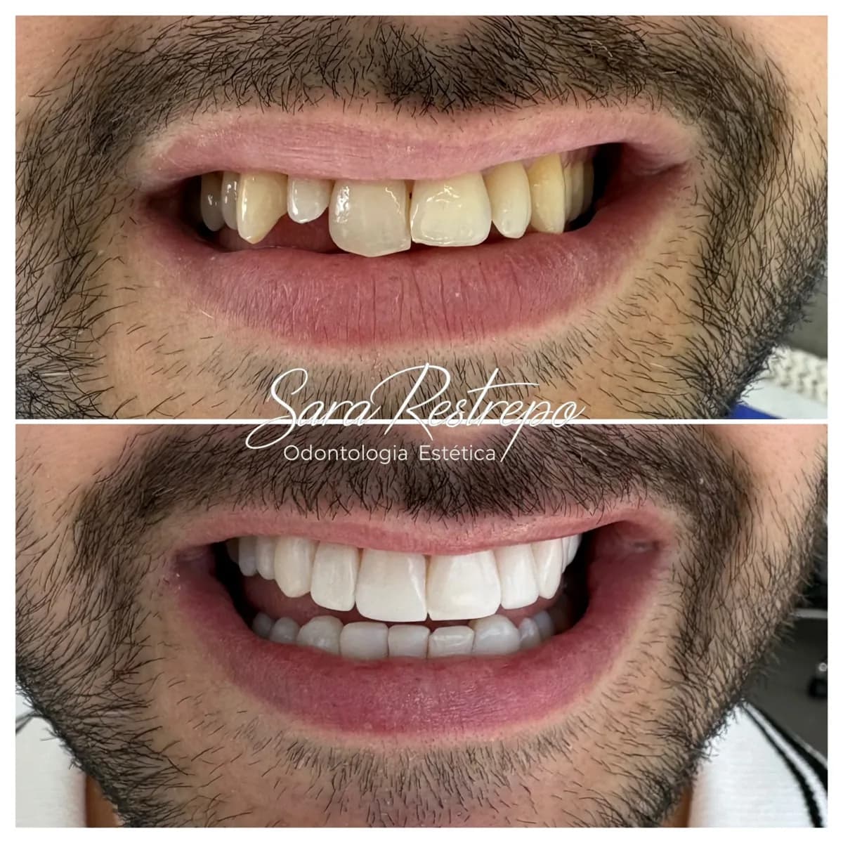 Diseño de sonrisa en resina, antes y después: corrección de forma y alineación visual