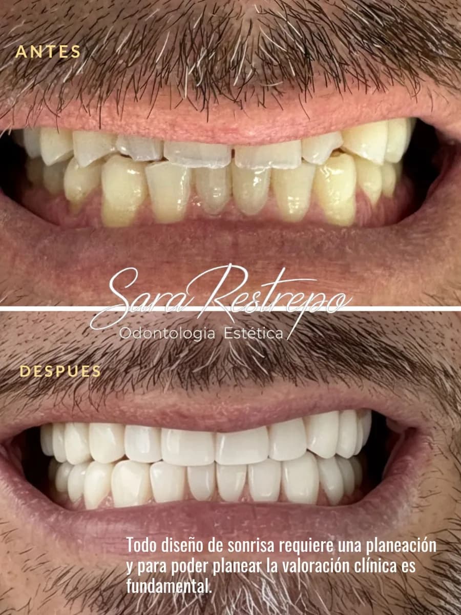 Diseño de sonrisa en resina en Cali, antes y después: dientes desgastados y amarillos