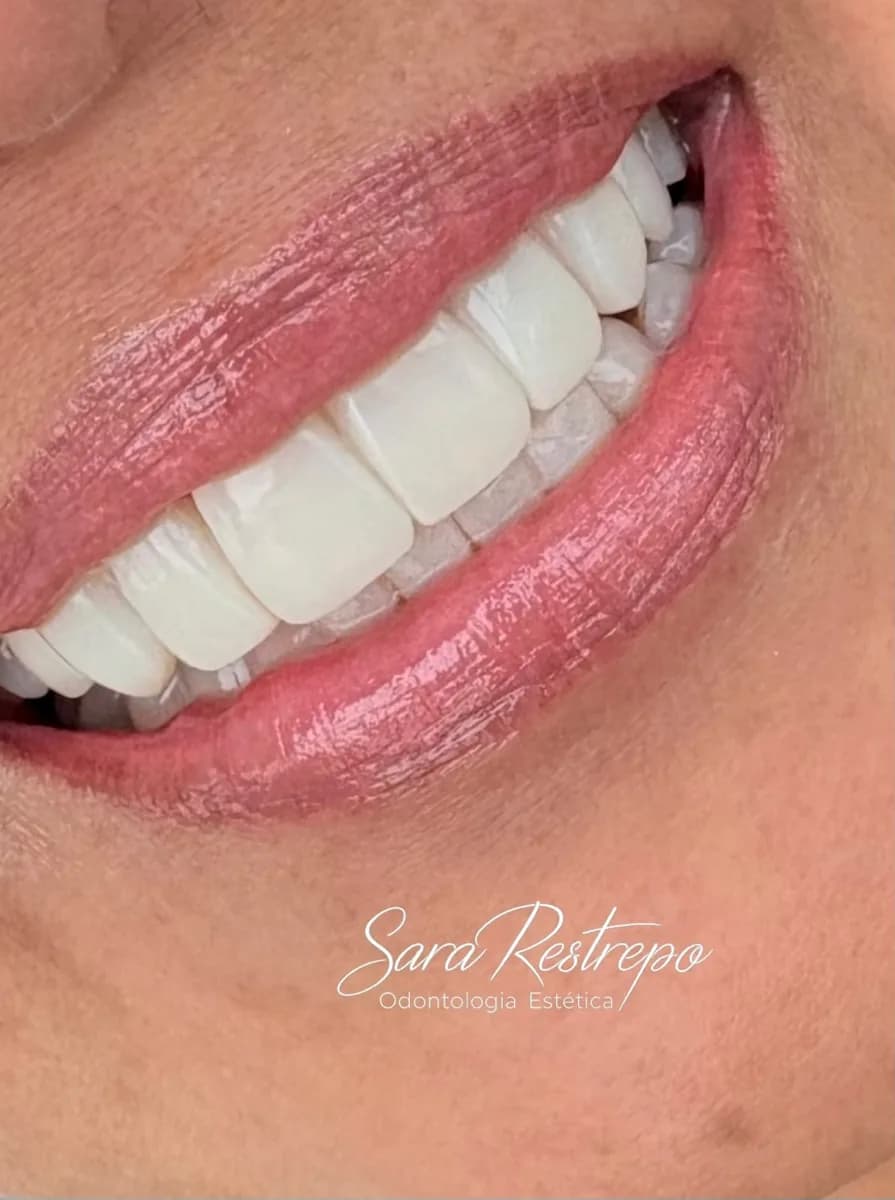 Resultado natural de diseño de sonrisa en resina – Dra. Sara Restrepo