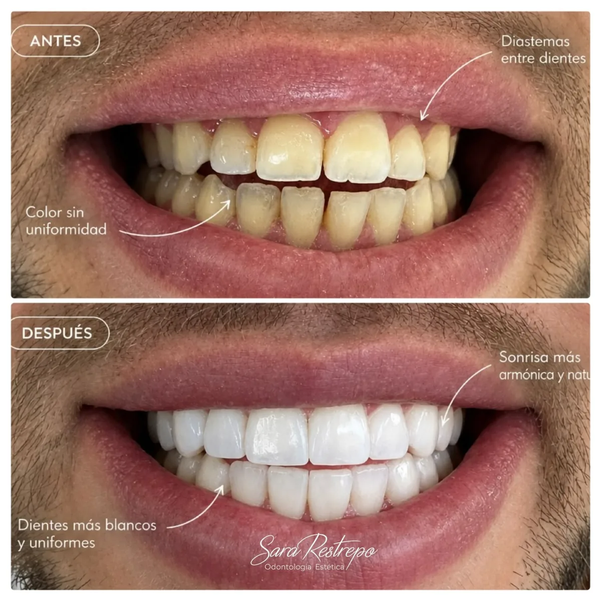 Mini diseño de sonrisa en Cali, antes y después: cierre de diastemas y color uniforme