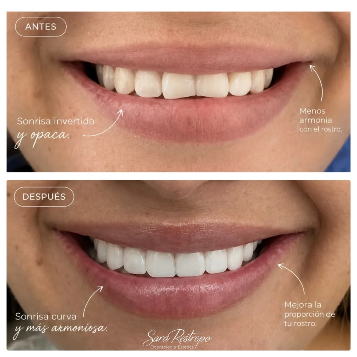 Mini diseño de sonrisa, antes y después: de sonrisa invertida y opaca a sonrisa curva y armoniosa