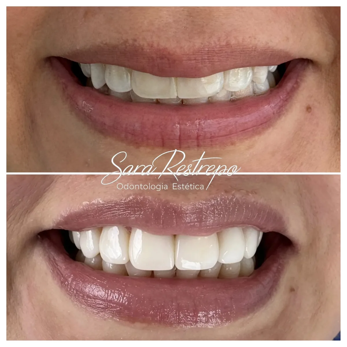 Mini diseño de sonrisa en Cali, antes y después: forma y proporción de los dientes frontales