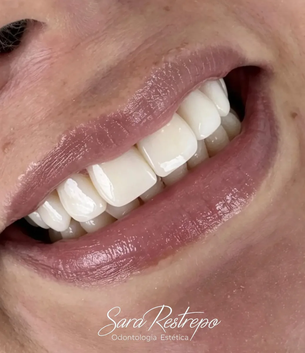 Resultado natural de mini diseño de sonrisa – Dra. Sara Restrepo