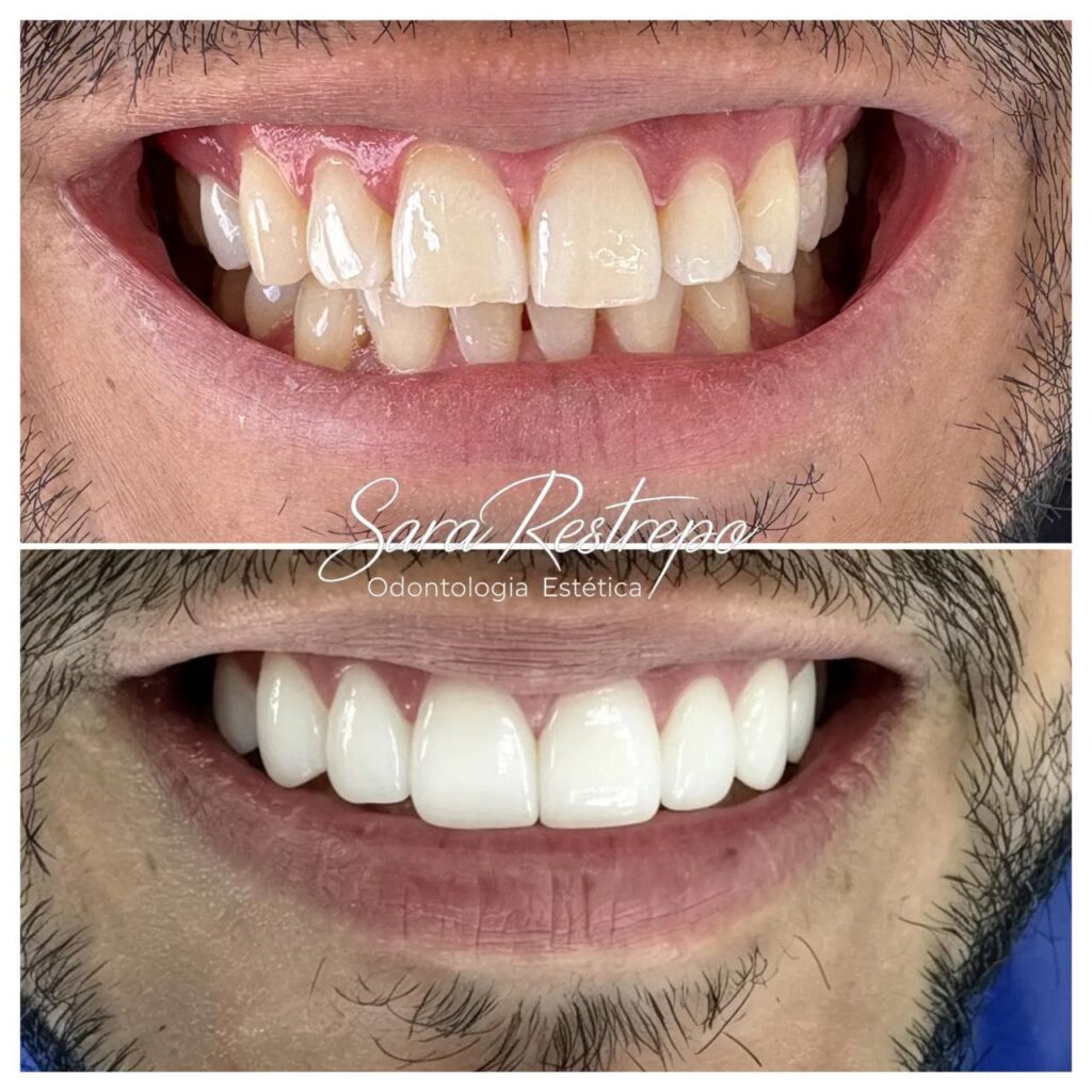 blanqueamiento dental