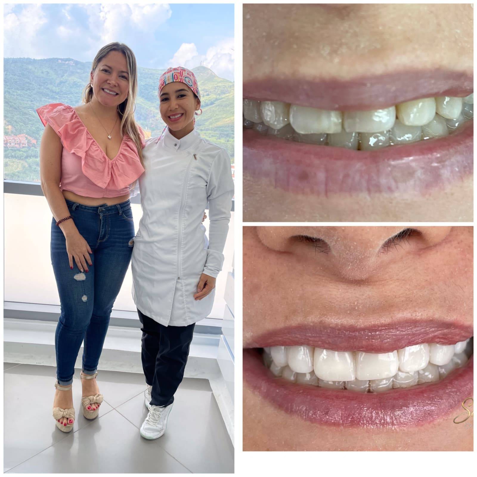 diseño de sonrisa Cali
