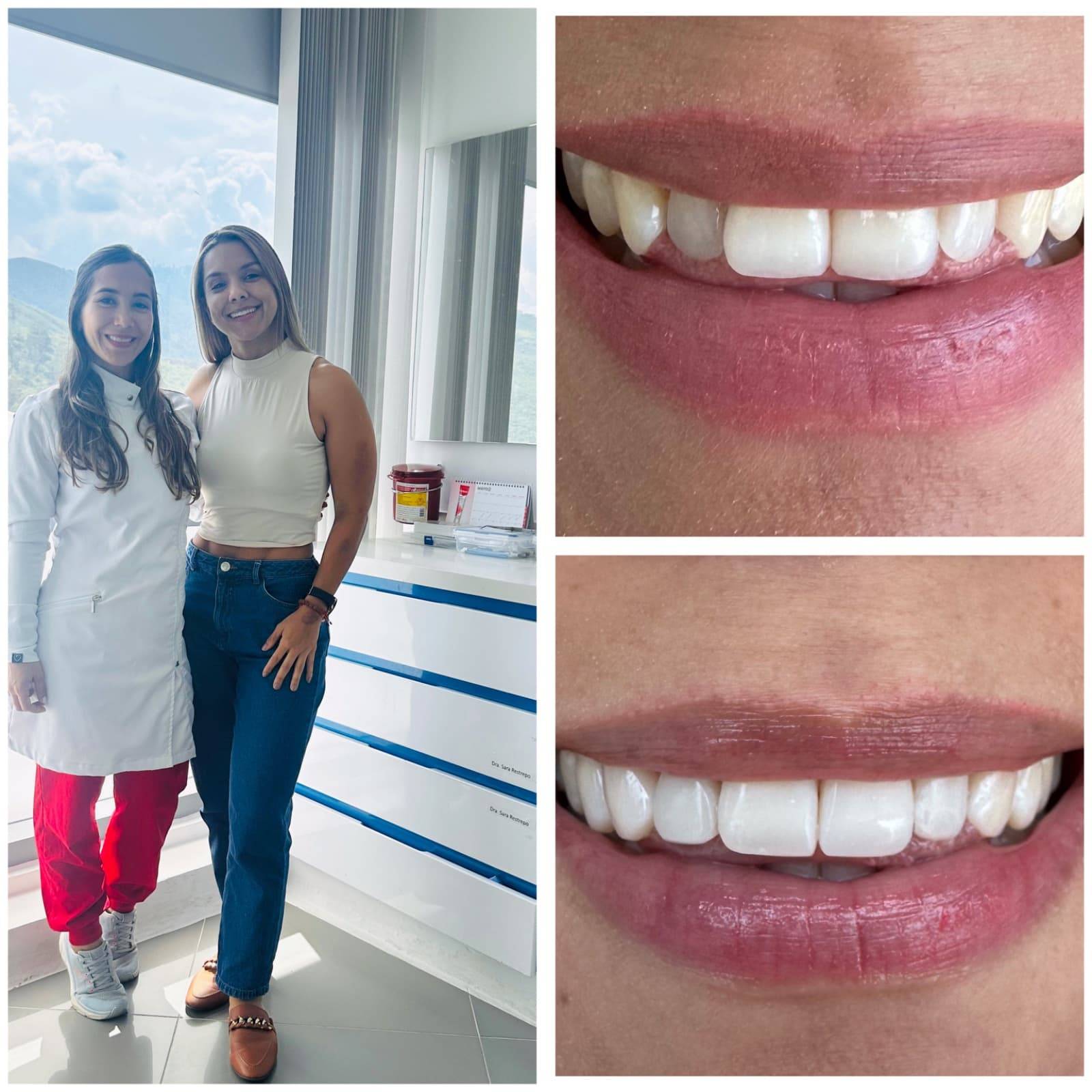 diseño de sonrisa Cali
