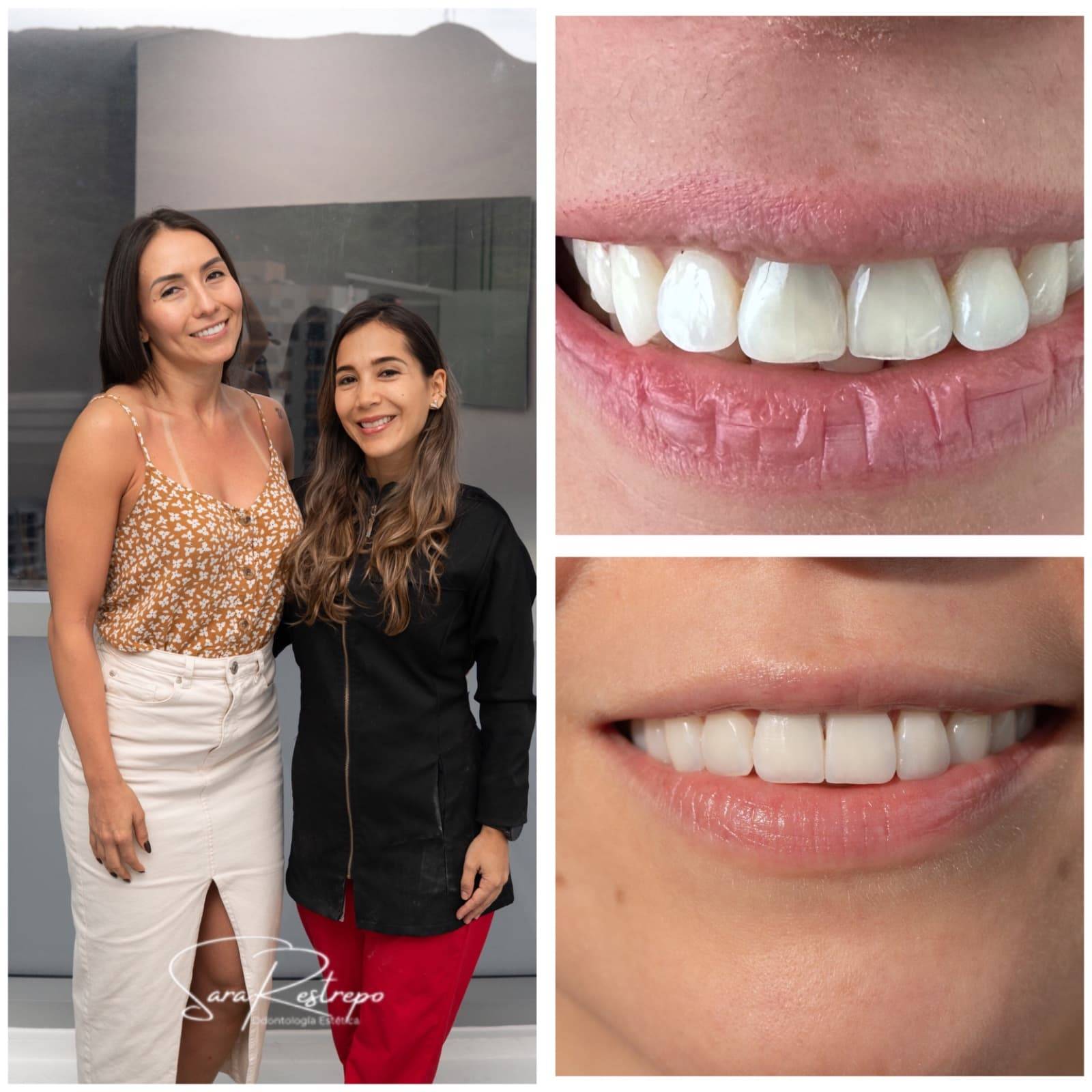 diseño de sonrisa Cali